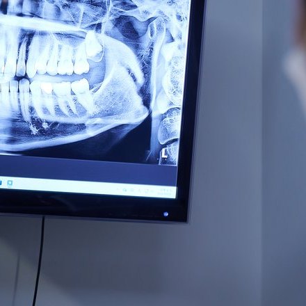 파노라마 영상으로 뺀 자리에 뼈가 차오른 것을 확인하는 장면
